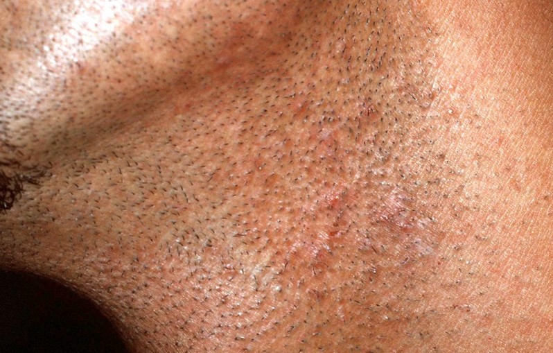 how to get rid of razor bumps on neck